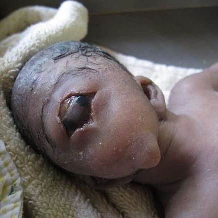 Mother Left Heartbroken After Giving Birth To A Cyclops Baby 