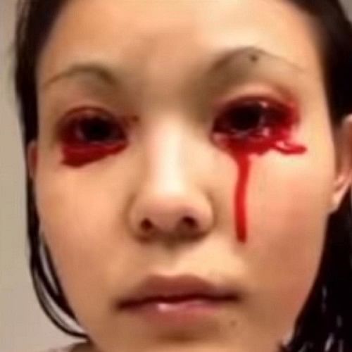 Linnie Ikeda from Hawaii suffering Gardner-Diamond Syndrome bleeds from eyes and tongue