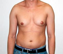 male breasts surgery decreased