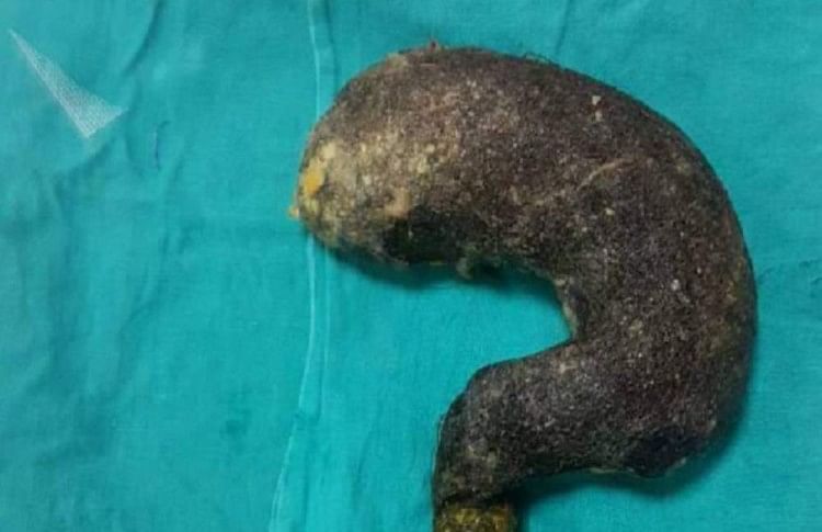 Hair bunch found in girl stomach during operation