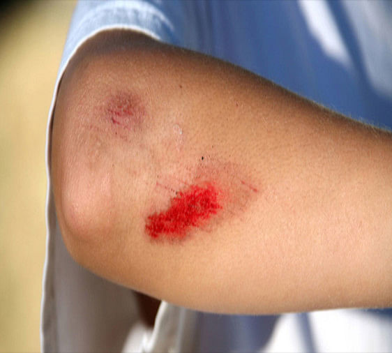 घाव का आसानी से न भरना इम्यूनिटी में कमजोरी का हो सकता है संकेत