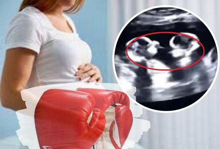 twins spotted fighting inside mother womb during ultrasound Video goes Viral 