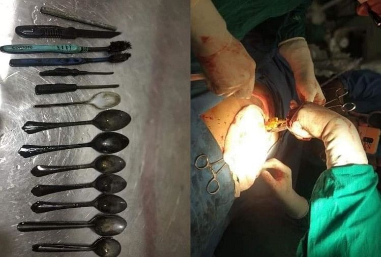 Doctors found toothbrush iron rod spoon and Screwdriver in patient stomach