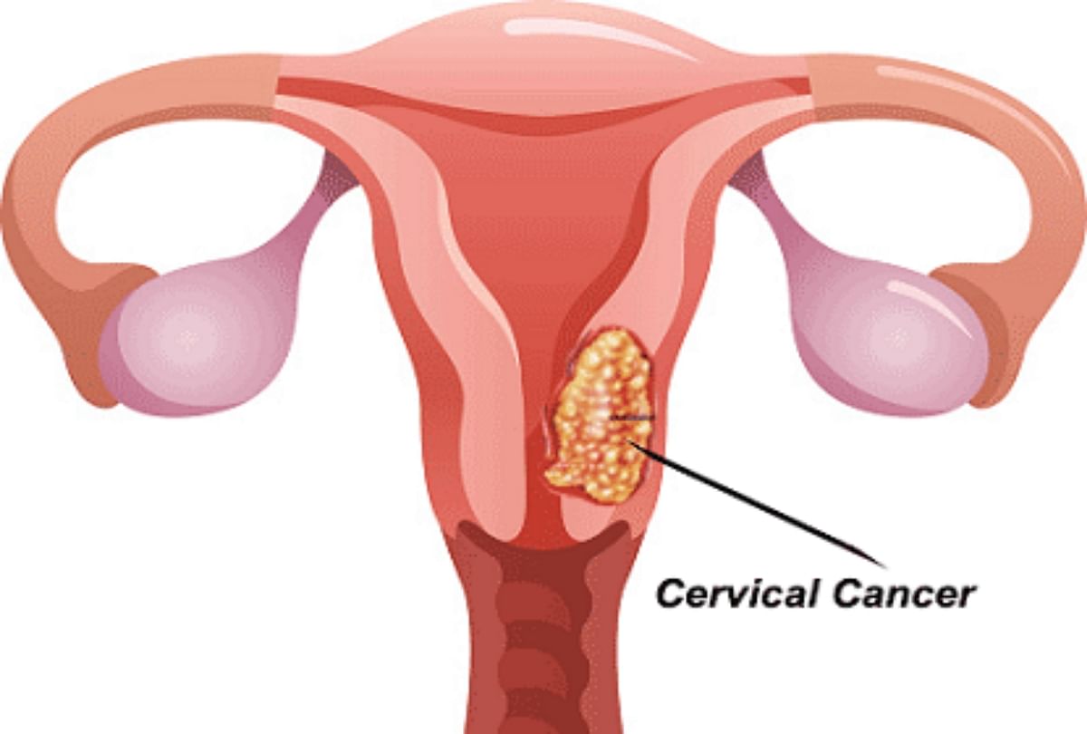 Cervical Cancer Screening Test Only In Five Rupees. - लखनऊ: सर्वाइकल कैंसर  का स्क्रीनिंग टेस्ट 5 रुपये मे, हर साल होती हैं 68 हजार मौतें - Amar Ujala  Hindi News Live
