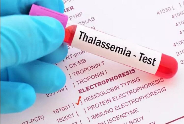 Les patients atteints de thalassémie peuvent être transplantés même en demi-match