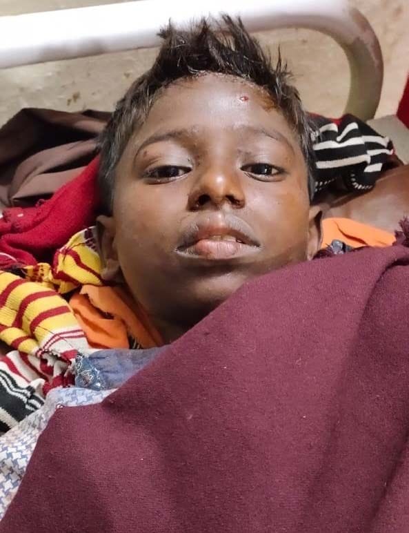 संग्रामपुर थाने के प्रतापपुर गांव में शादी समारोह के दौरान अतिशबाजी में झुलसा बालक साहिल सरोज। संग्रामपुर थाने के प्रतापपुर गांव में शादी समारोह के दौरान अतिशबाजी में झुलसा बालक साहिल सरोज।