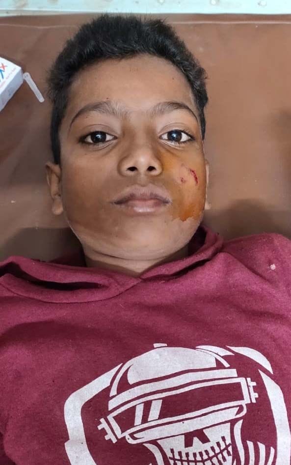 संग्रामपुर थाने के प्रतापपुर गांव में शादी समारोह के दौरान अतिशबाजी में झुलसा बालक दिनेश निर्मल संग्रामपुर थाने के प्रतापपुर गांव में शादी समारोह के दौरान अतिशबाजी में झुलसा बालक दिनेश निर्मल
