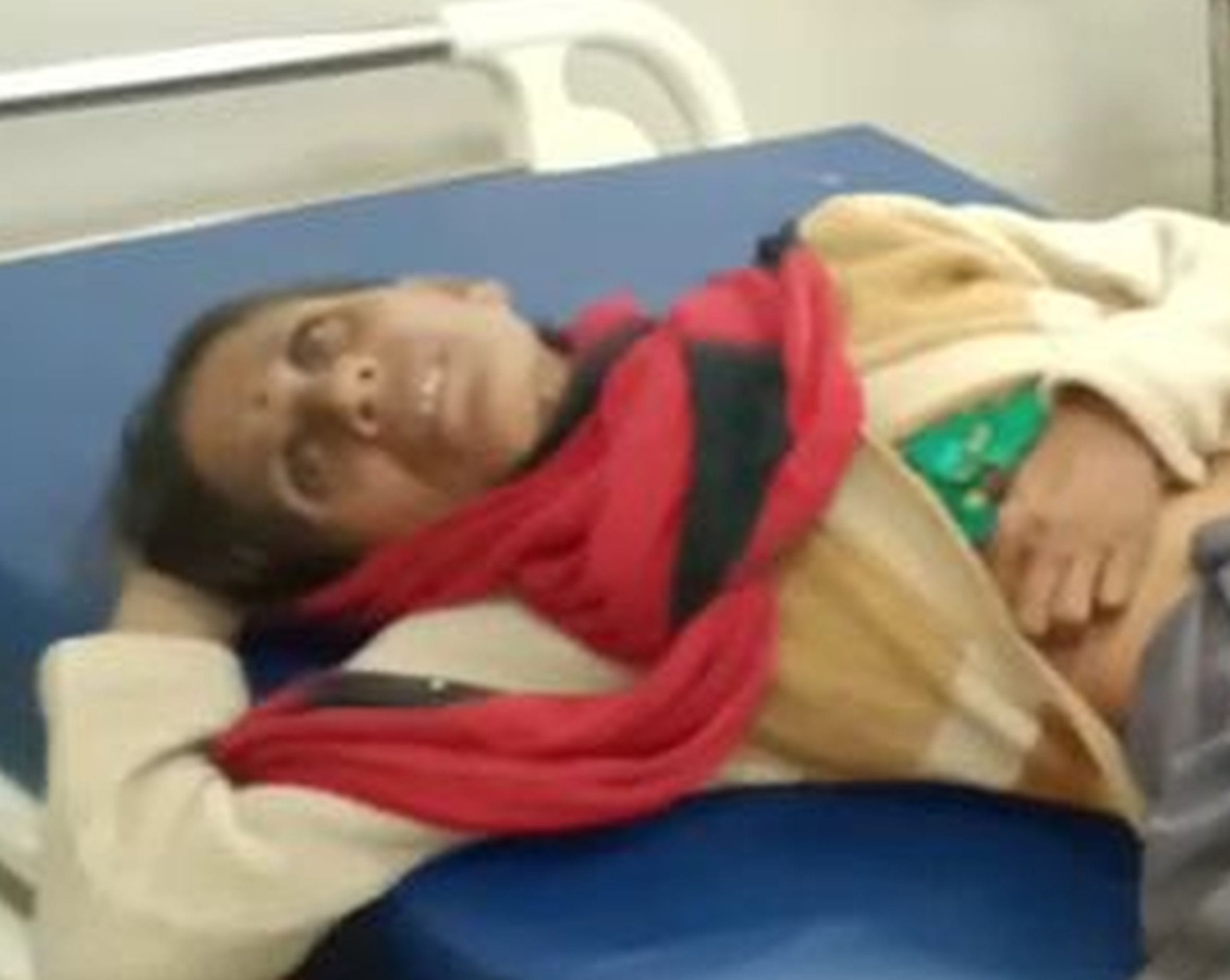 ज्वलनशील पदार्थ से जले लोग। ज्वलनशील पदार्थ से जले लोग।