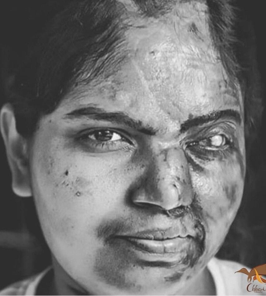 बिजनौर निवासी छपाक फिल्म की किरदार बाला। बिजनौर निवासी छपाक फिल्म की किरदार बाला।
