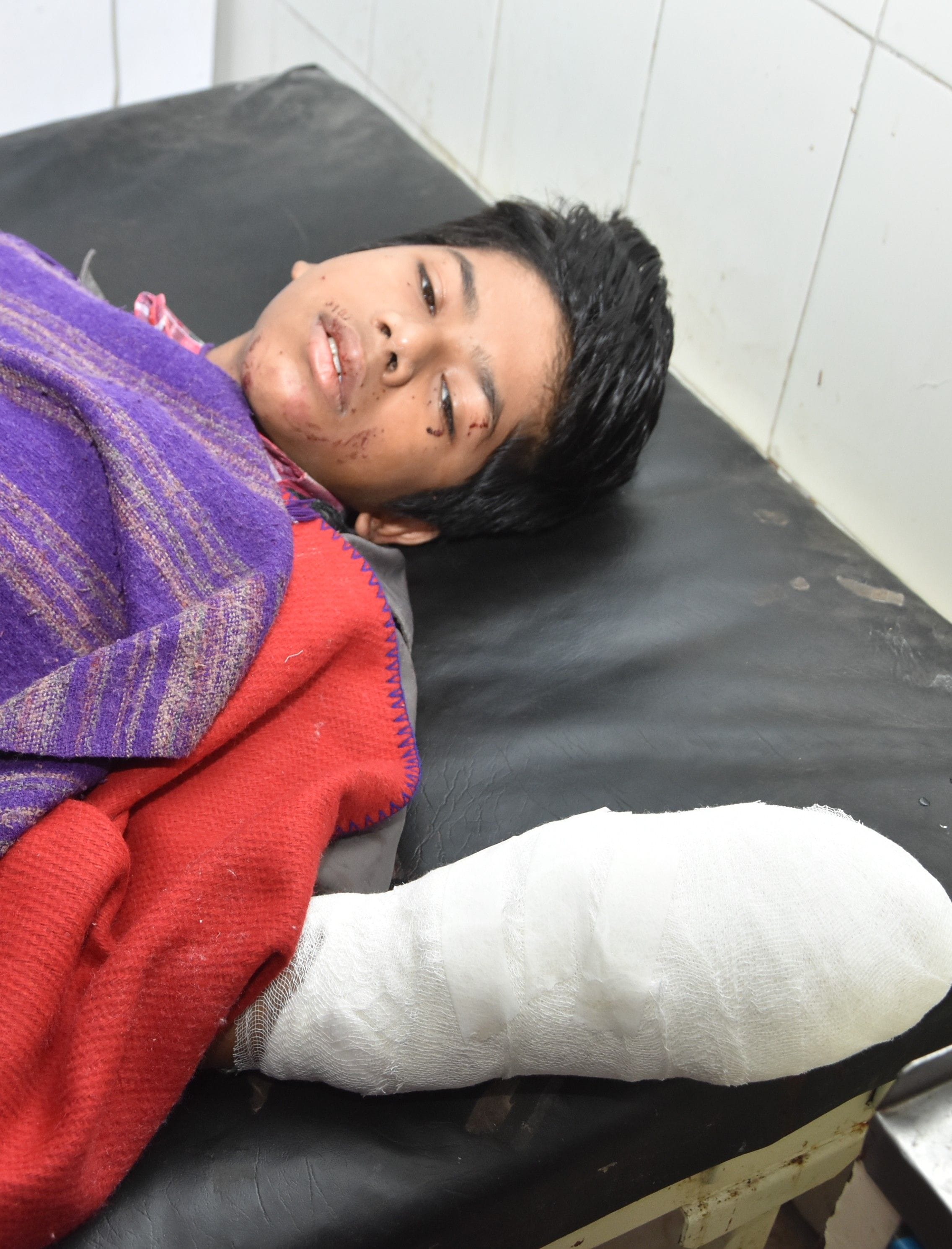Bomb explodes while heating fire, teenager's claw blows