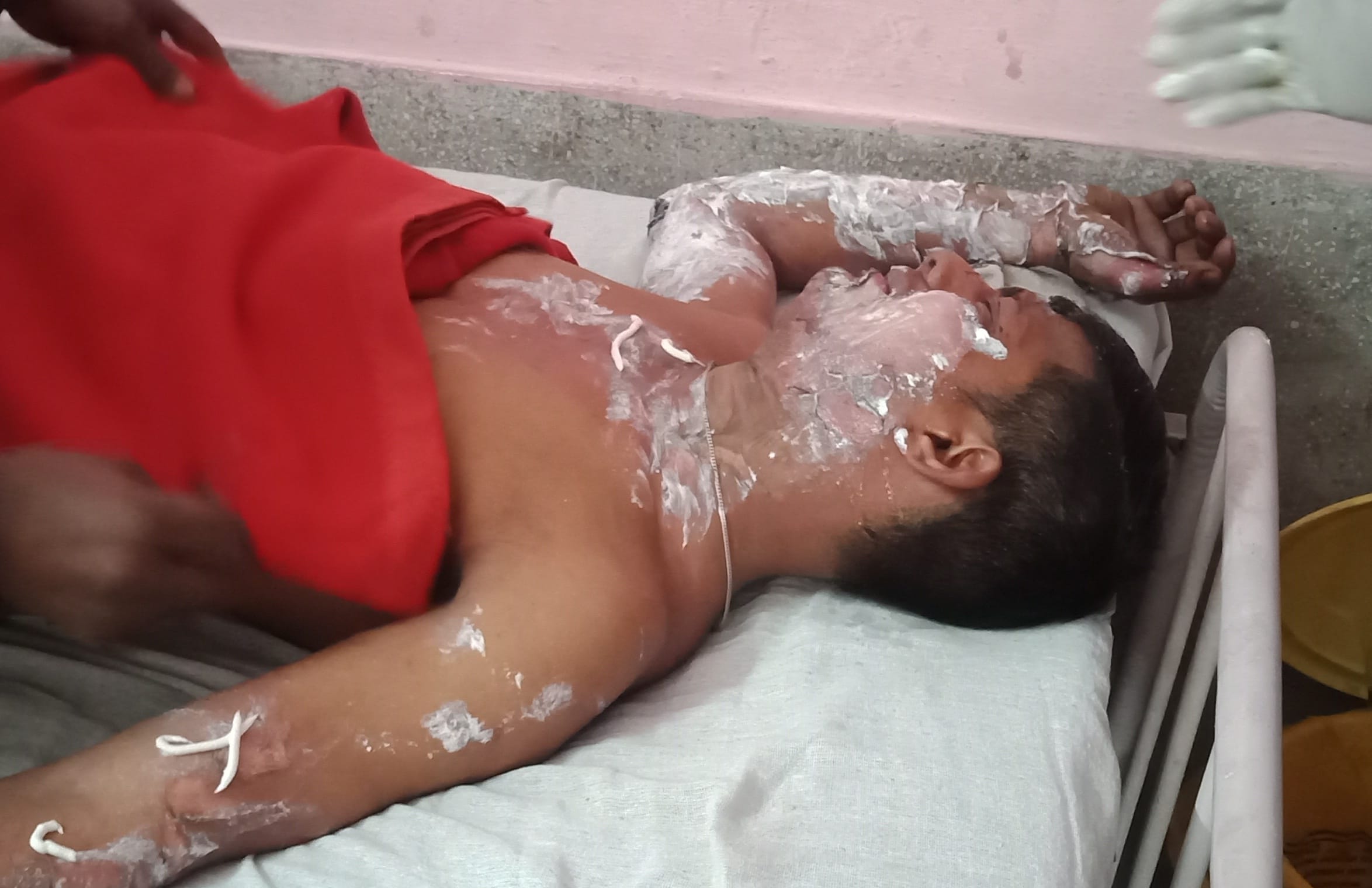 थानाभवन (शामली) में अलाव से झुलसा युवक रवि। थानाभवन (शामली) में अलाव से झुलसा युवक रवि।
