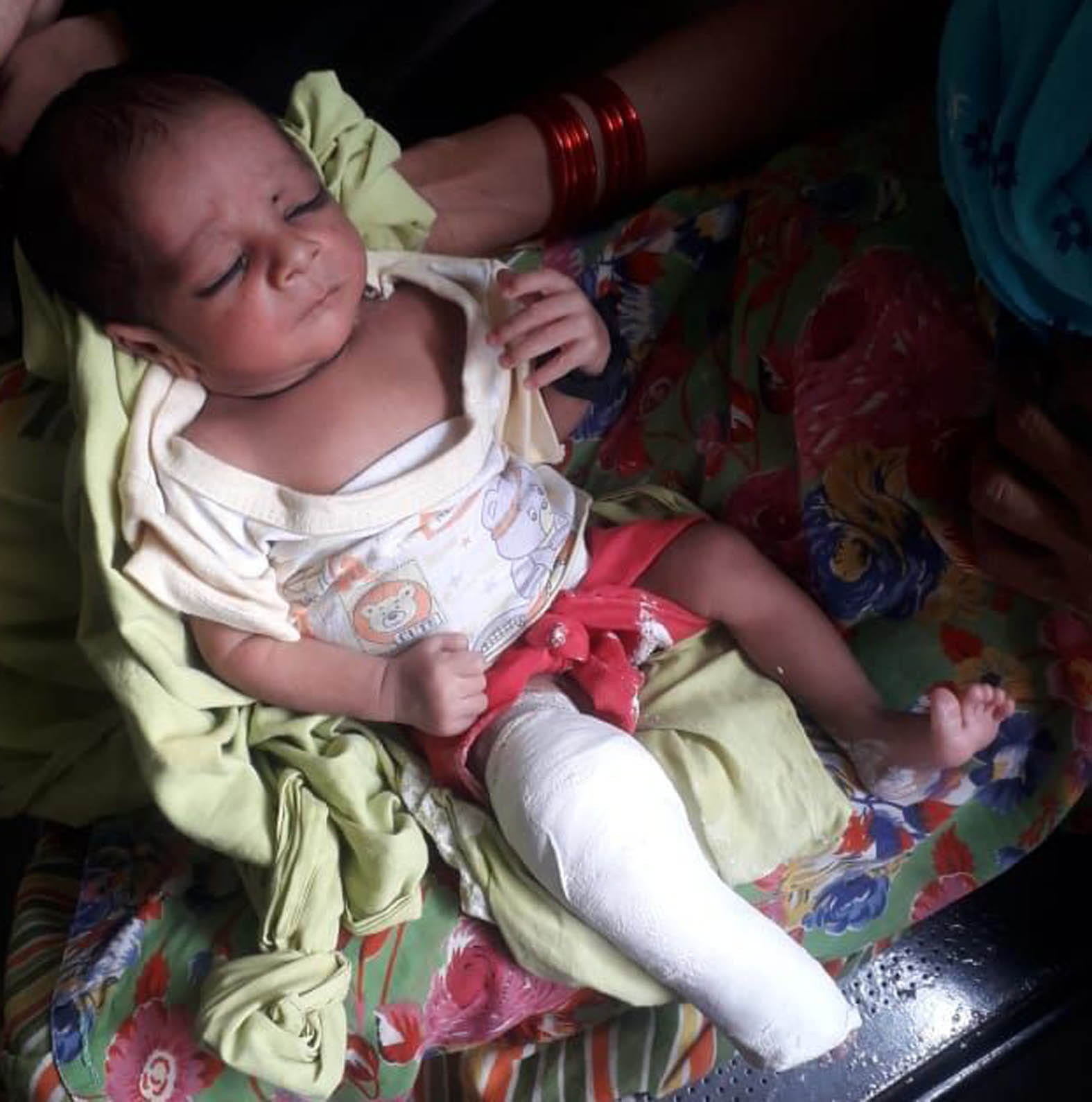 पलक के पैर में चढ़ा प्लास्टर। पलक के पैर में चढ़ा प्लास्टर।