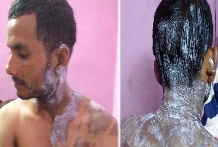 Image result for unnao man acid attack