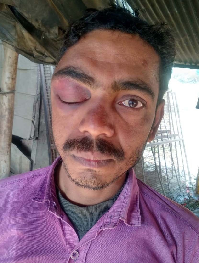 पट्टी कोतवाली के उड़ैयाडीह में दबंगों की पिटाई से घायल व्यापारी रामू मौर्य।