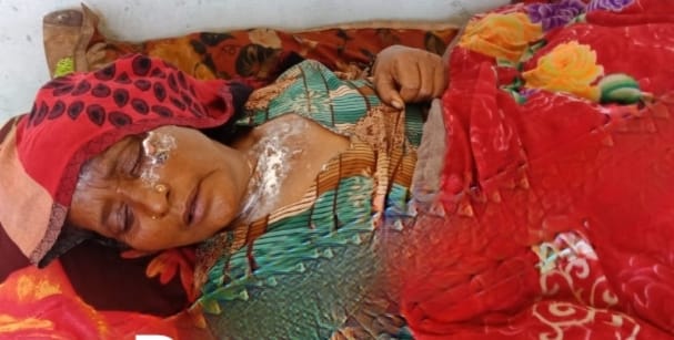 बेहट के गांव फैजाबाद में आग लगने से झुलसी महिला। बेहट के गांव फैजाबाद में आग लगने से झुलसी महिला।