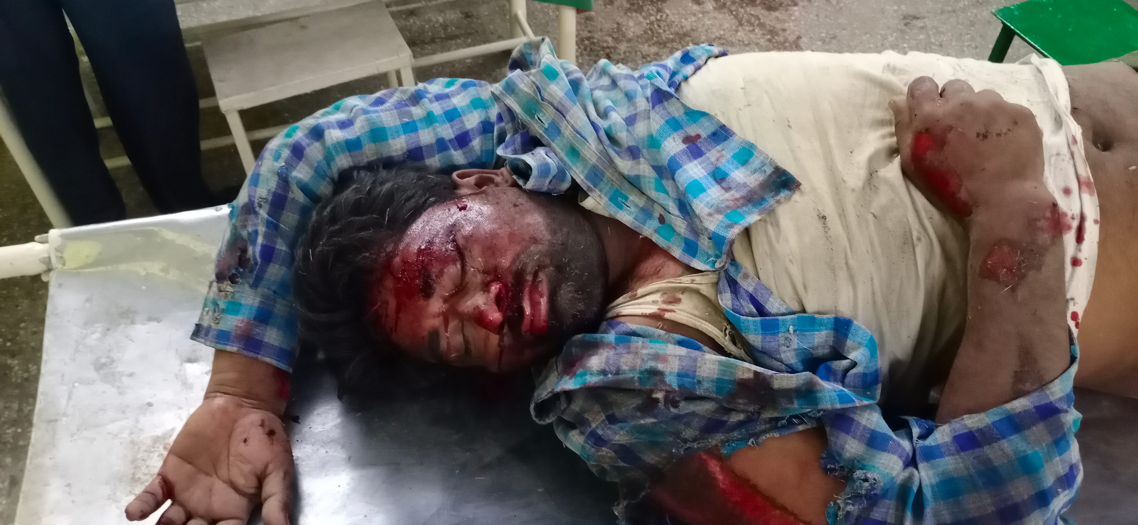 जानसठ में गाड़ी पलटने से घायल मजदूर। जानसठ में गाड़ी पलटने से घायल मजदूर।