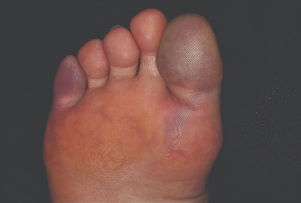 Blisters In The Feet May Also Be An Early Symptom Of Coronavirus Infection क र न व यरस प र म छ ल भ ह सकत ह स क रमण क श र आत लक षण Amar Ujala Hindi News Live