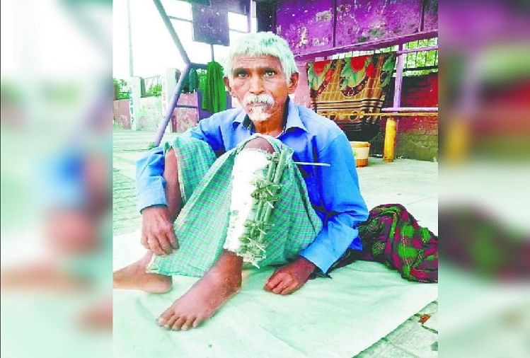 पैर में फ्रैक्चर का मरीज