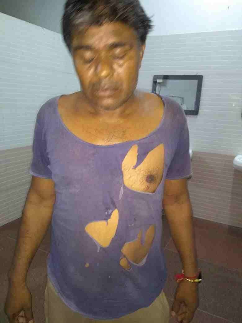 घायल चालक कैलाश। घायल चालक कैलाश।
