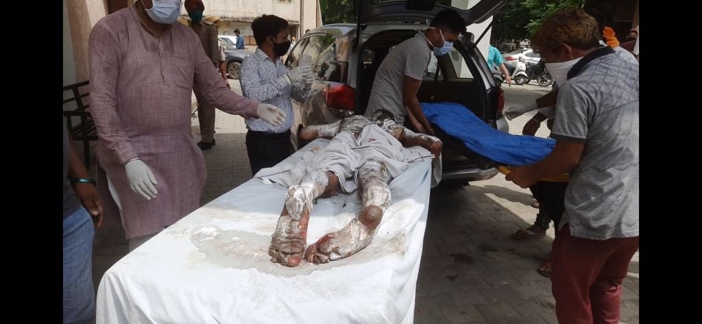 मंडी गोबिंदगढ़ के सिविल अस्पताल में फर्नेस इकाई के हादसे में झुलसे मजदूरों को चंडीगढ़ पीजीआई ले ?