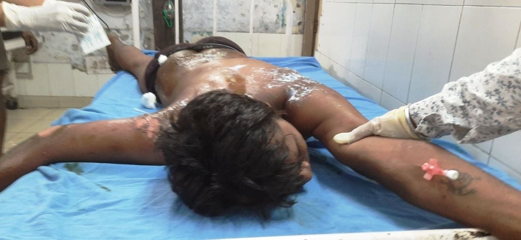 मंडी गोबिंदगढ़ के सिविल अस्पताल में फर्नेस इकाई के हादसे में झुलसे मजदूर।
