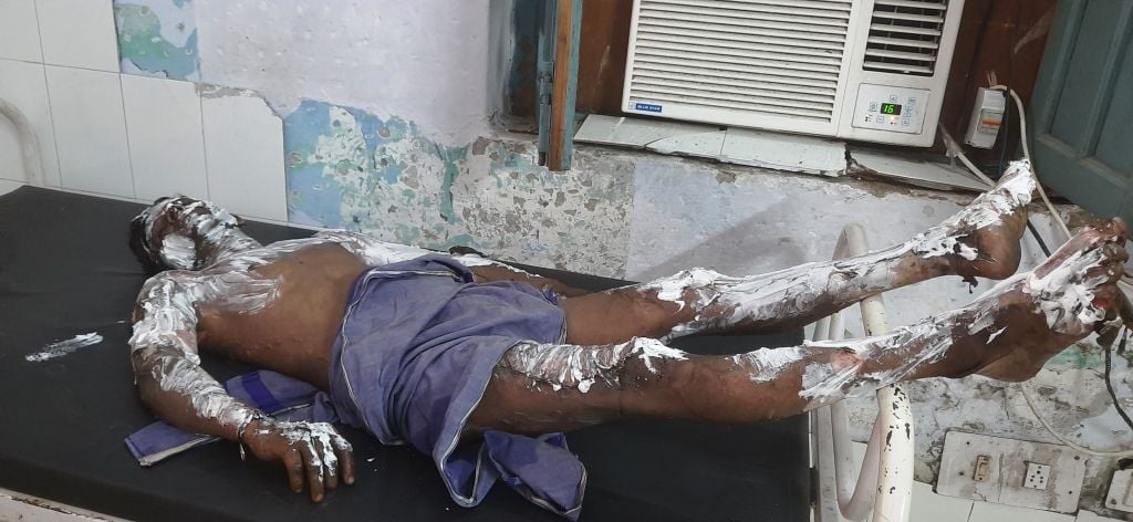 मंडी गोबिंदगढ़ के सिविल अस्पताल में फर्नेस इकाई के हादसे में झुलसे मजदूर।