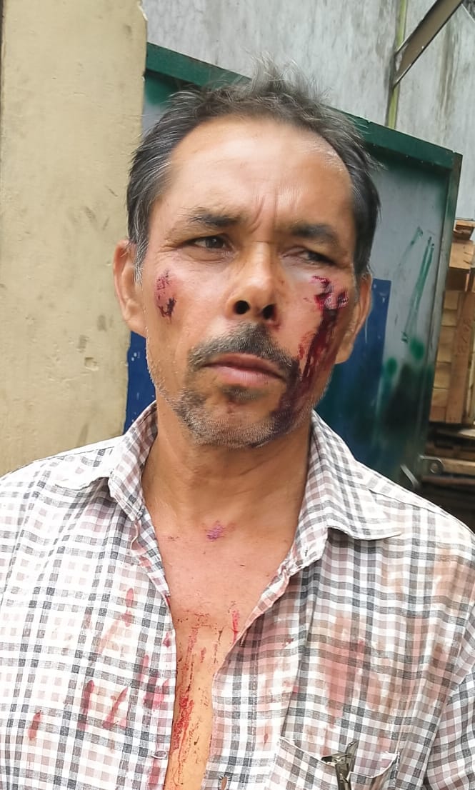 बिजनौर:  लेखपाल से मारपीट की घटना में घायल किसान टीकम सिंह ।