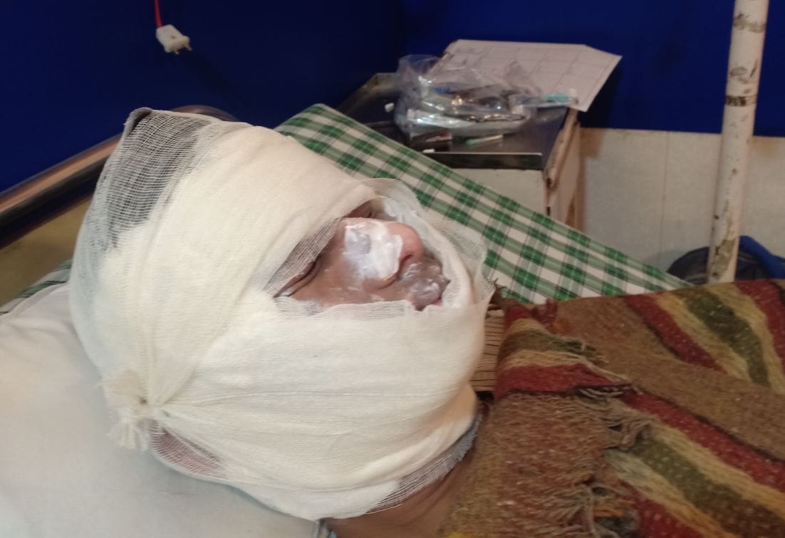 काशीपुर में हाइड्रोजन का गुब्बारा फटने से झुलसा होटलकर्मी अभिषेक। काशीपुर में हाइड्रोजन का गुब्बारा फटने से झुलसा होटलकर्मी अभिषेक।