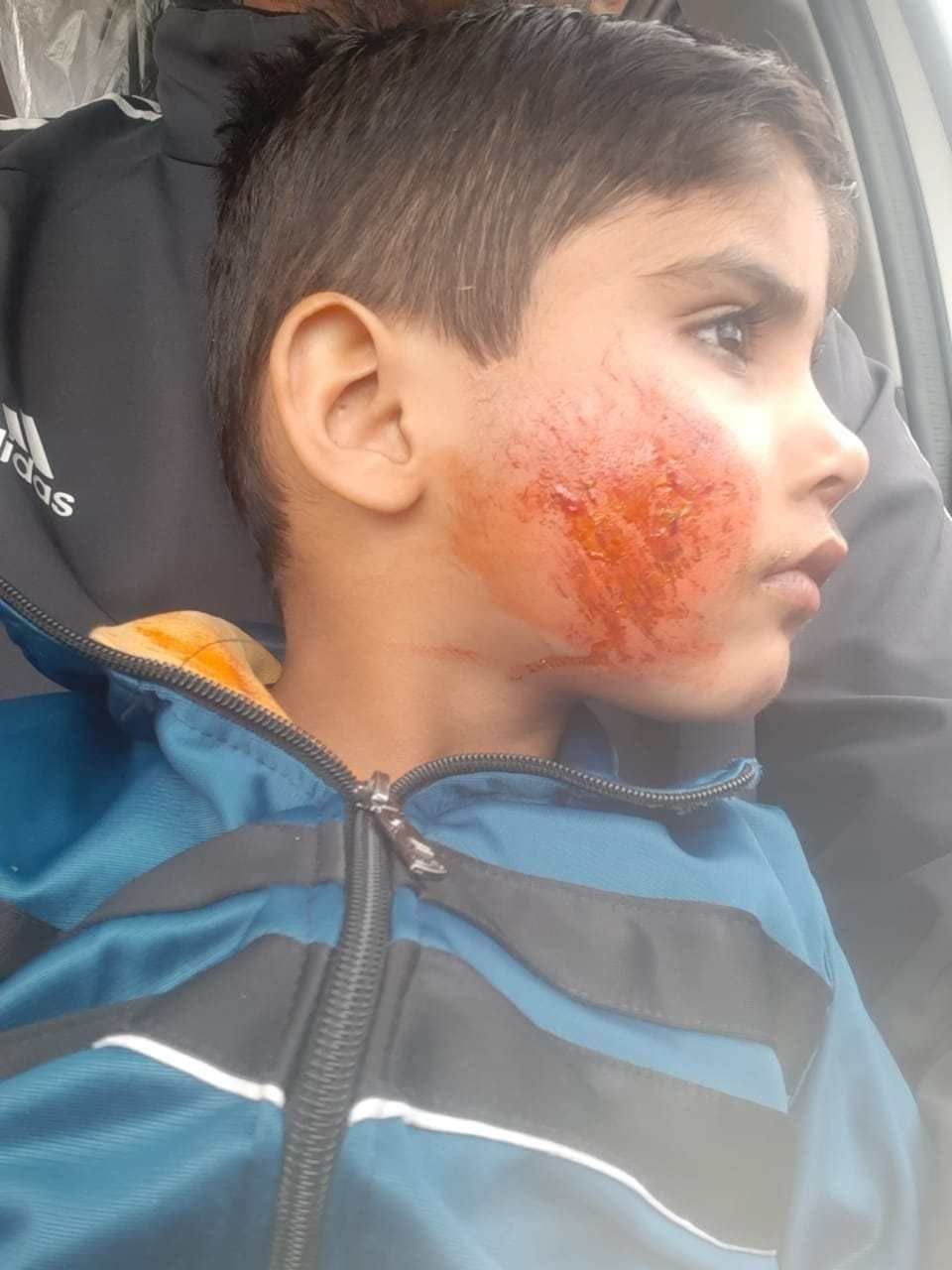 बस से गिरकर घायल हुआ पहली कक्षा का छात्र हर्षित। बस से गिरकर घायल हुआ पहली कक्षा का छात्र हर्षित।