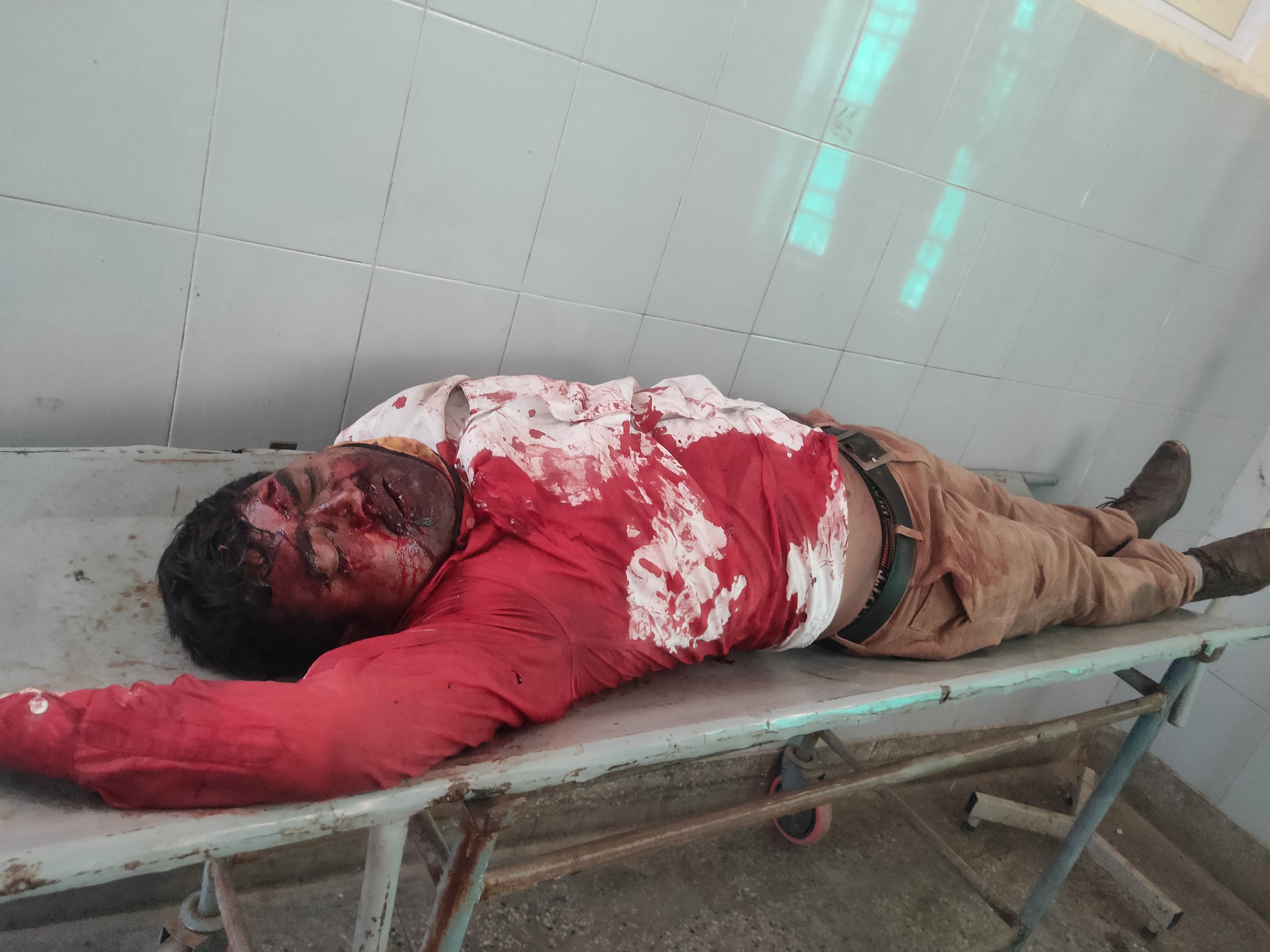 फोटो24एयूआरपी 19- अस्पताल में भर्ती पेड़ की चपेट में आकर लहूलुहान हुए आविद सिद्दी फोटो24एयूआरपी 19- अस्पताल में भर्ती पेड़ की चपेट में आकर लहूलुहान हुए आविद सिद्दी