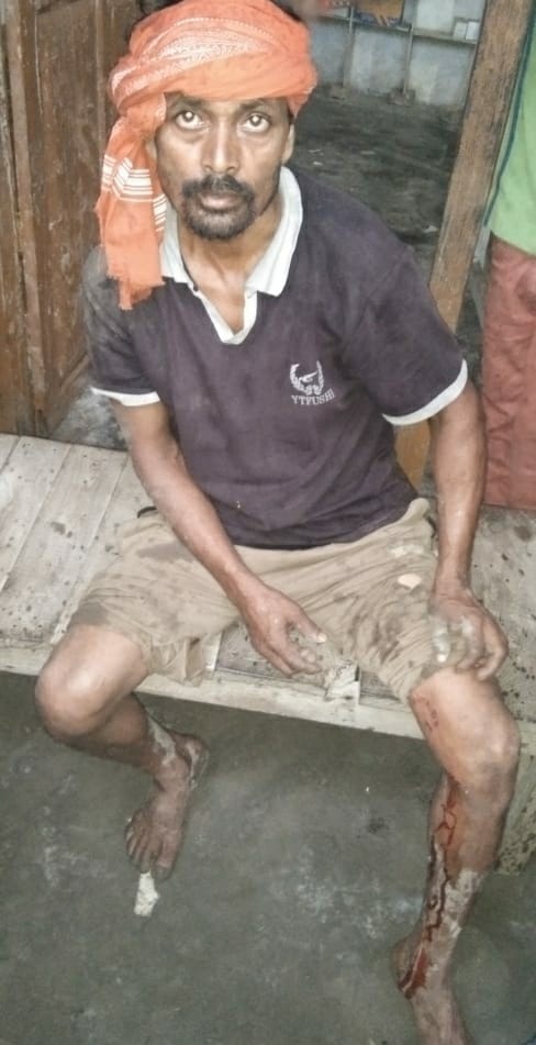 तेंदुए के हमले से घायल छोटेलाल। संवाद न्यूज एजेंसी। तेंदुए के हमले से घायल छोटेलाल। संवाद न्यूज एजेंसी।