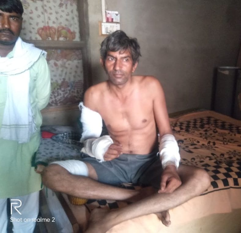 कुतों द्वारा घायल युवक जख्म दिखाते हुए। कुतों द्वारा घायल युवक जख्म दिखाते हुए।