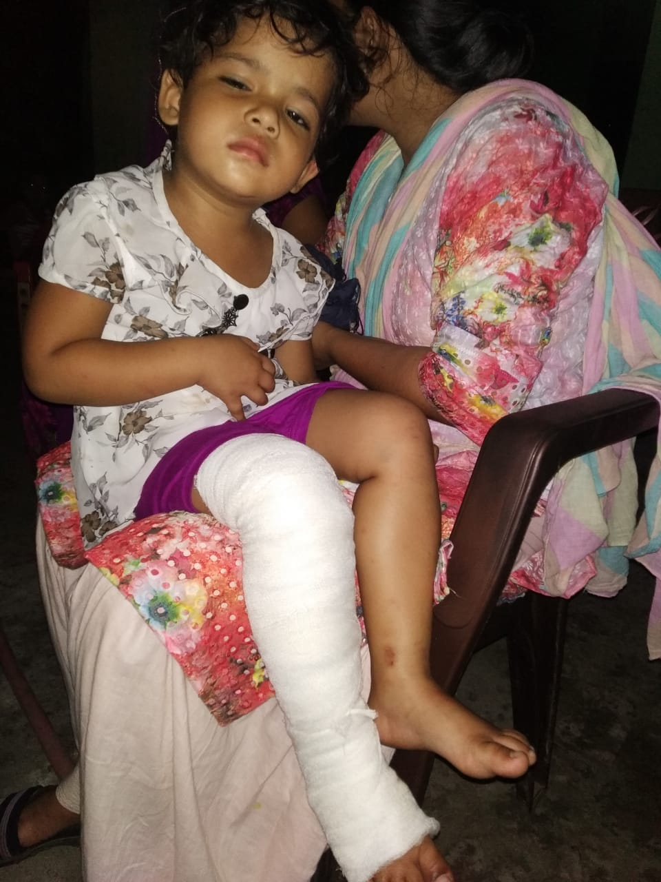 मीरापुर में गिरी दीवार की चपेट में आकर घायल हुई बच्ची। मीरापुर में गिरी दीवार की चपेट में आकर घायल हुई बच्ची।