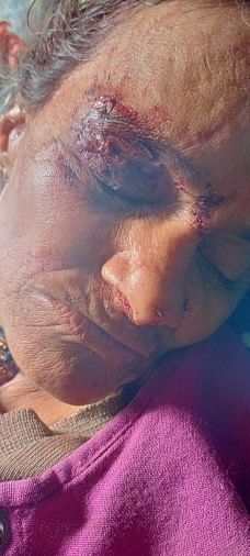 ओखलकांडा में भालू के हमले से घायल महिला। संवाद न्यूज एजेंसी
