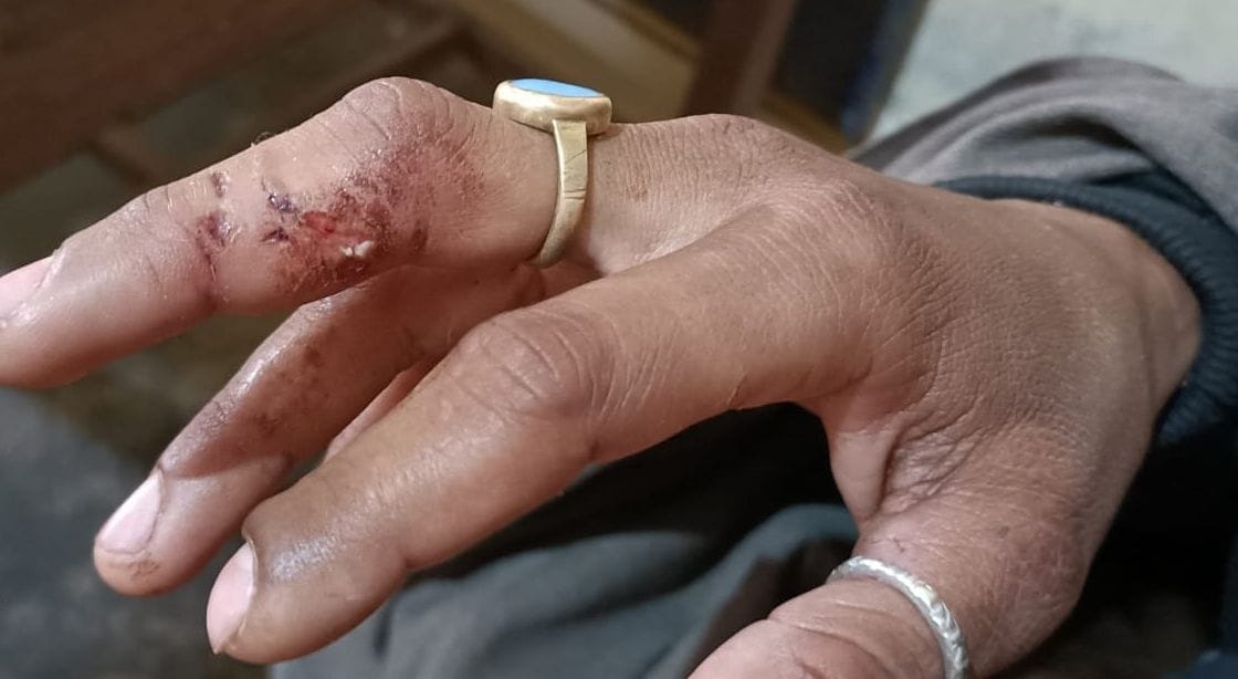 आरोपी नेहा के हांथ में बने जख्म। संवाद आरोपी नेहा के हांथ में बने जख्म। संवाद