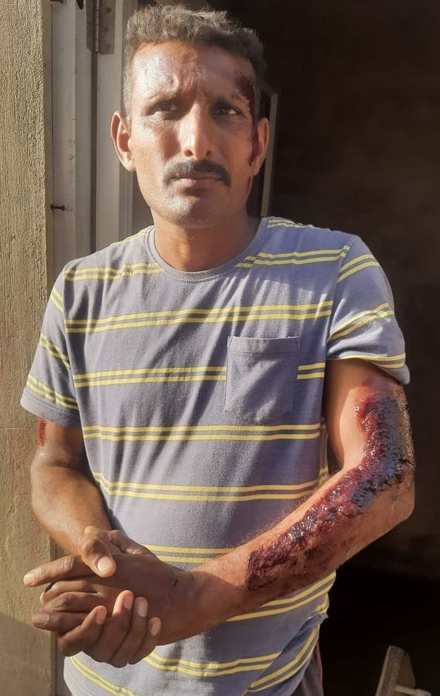 आग की चपेट में आने से झुलसा कमल सिंह। संवाद आग की चपेट में आने से झुलसा कमल सिंह। संवाद