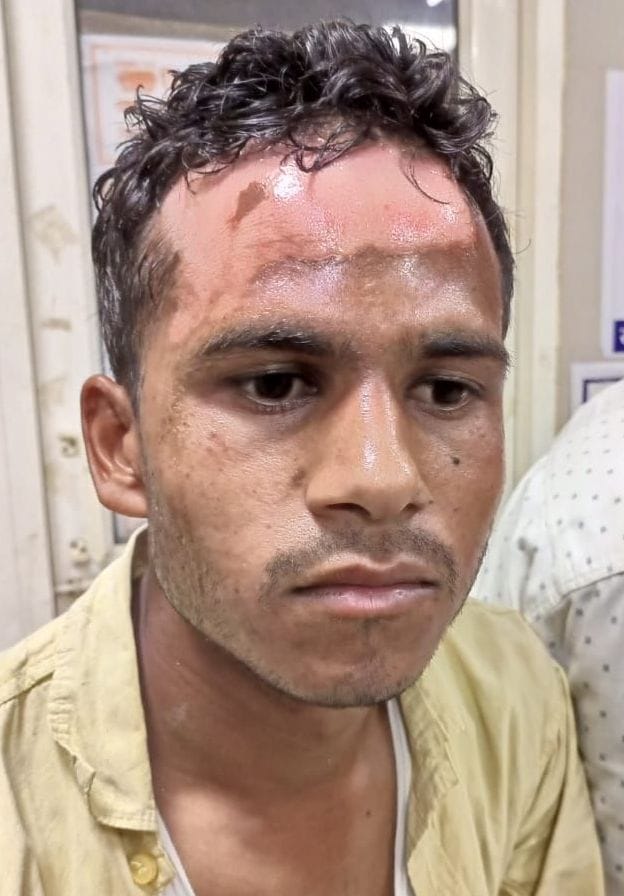 एसिड अटैक से झुलसा सिवेक पाल। संवाद