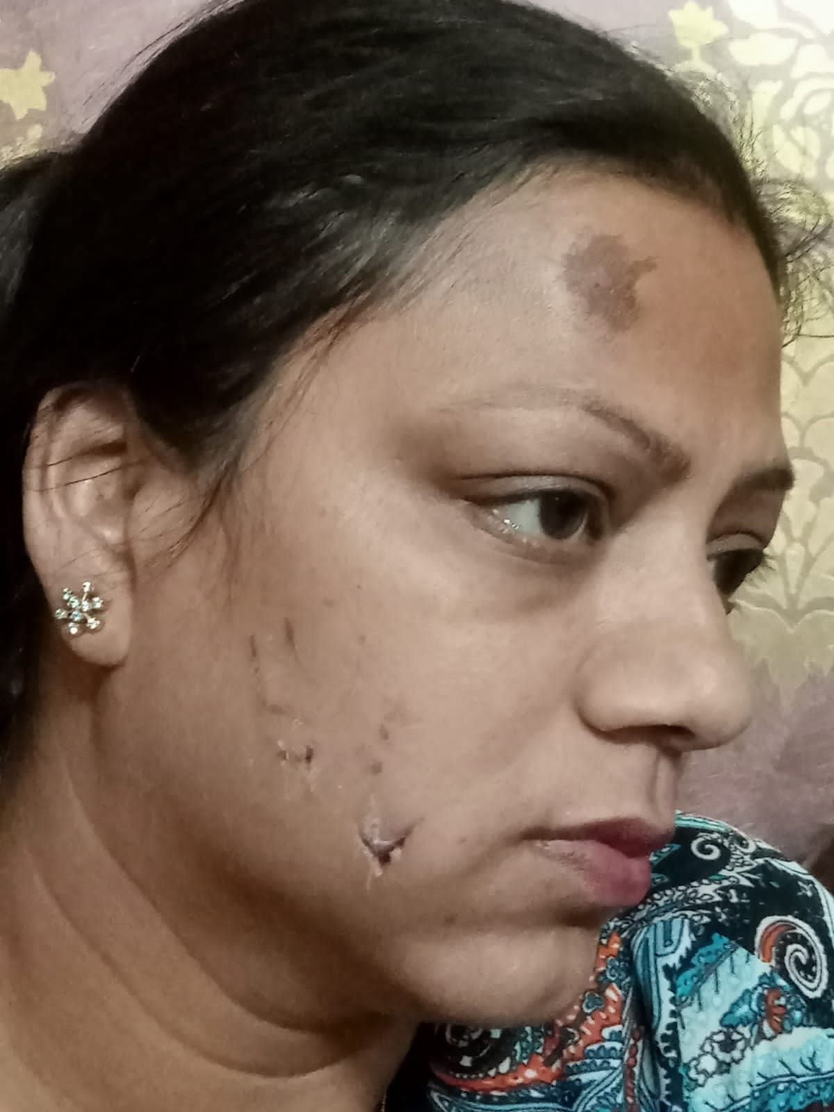 चेहरे पर पिटबुल के काटने के निशान। चेहरे पर पिटबुल के काटने के निशान।