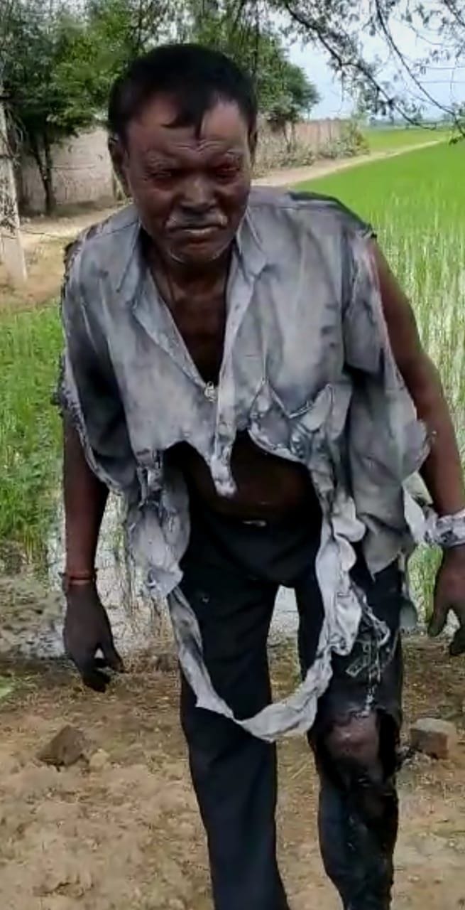 गांव नागपुर में हुए फैक्टरी हादसे में घायल मजदूर।