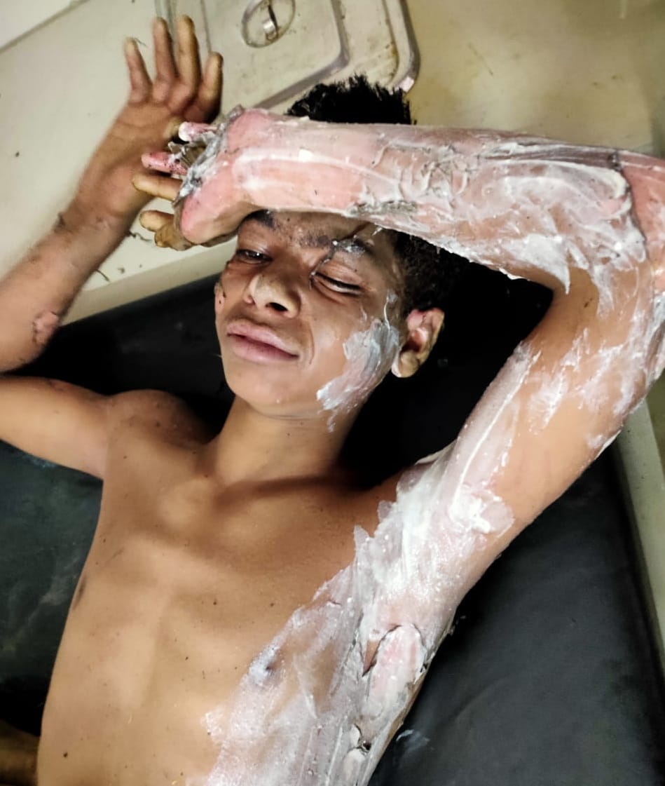 बोडपुर के हादसे में झुलसा किशोर बोडपुर के हादसे में झुलसा किशोर