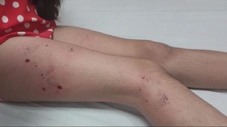 Ghaziabad: सोसायटी वाले कुत्तों से रहें सावधान, पिटबुल ने छात्रा पर किया हमला, पैर पर दिखे क्रूरता के निशान