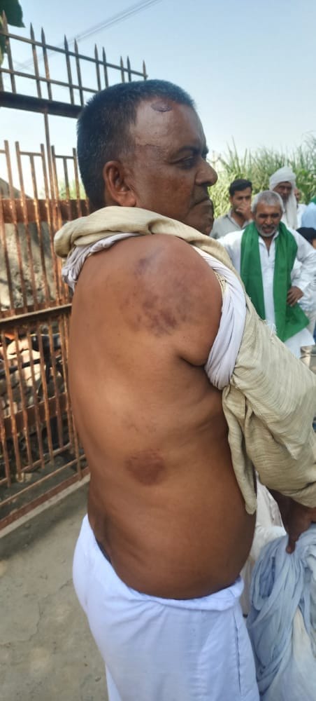 गढ़ीपुख्ता बिजलीघर पर विद्युतकर्मियों द्वारा की कई गई मारपीट के निशान दिखाता किसान। गढ़ीपुख्ता बिजलीघर पर विद्युतकर्मियों द्वारा की कई गई मारपीट के निशान दिखाता किसान।