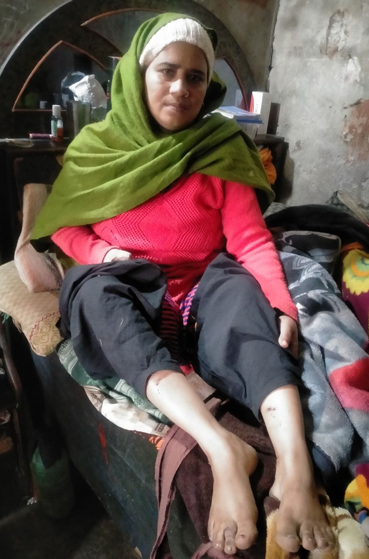 पिटबुल कुत्ते के हमले से घायल महिला बबीता।