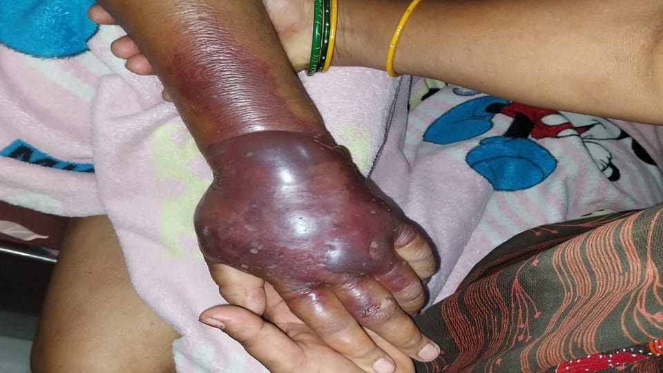 कीड़े के काटने के बाद हाथ का हाल