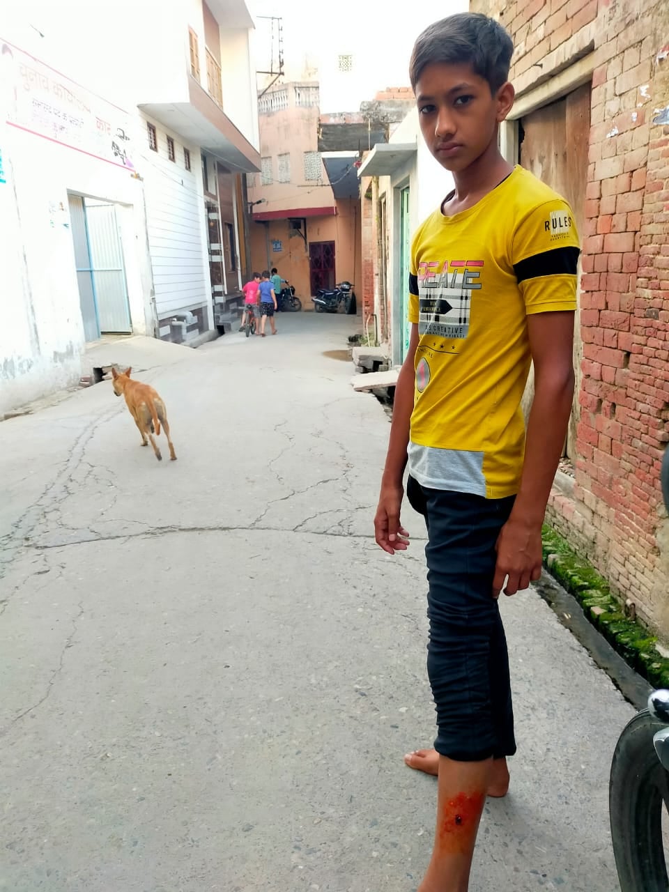 थाना भवन में पागल कुत्ते के हमले में घायल बच्चा थाना भवन में पागल कुत्ते के हमले में घायल बच्चा