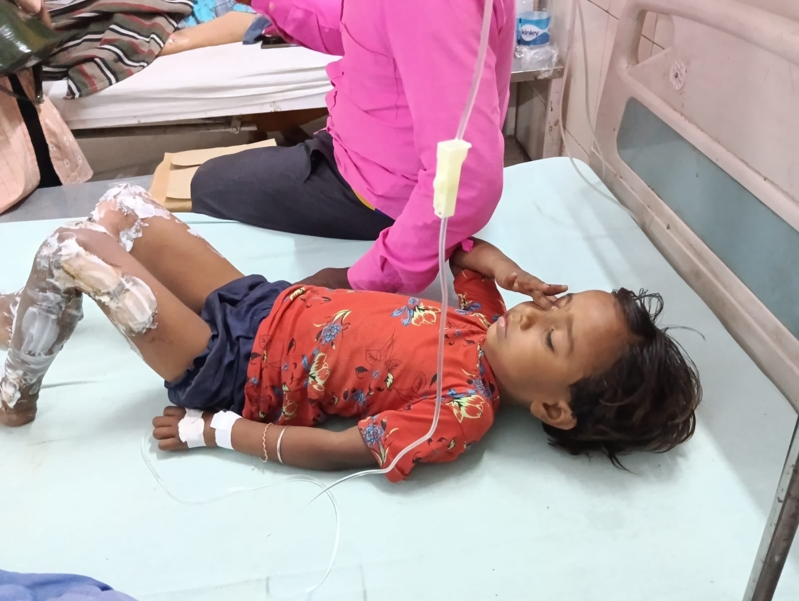 मेडिकल कॉलेज में भर्ती आग से झुलसा बच्चा । संवाद मेडिकल कॉलेज में भर्ती आग से झुलसा बच्चा । संवाद