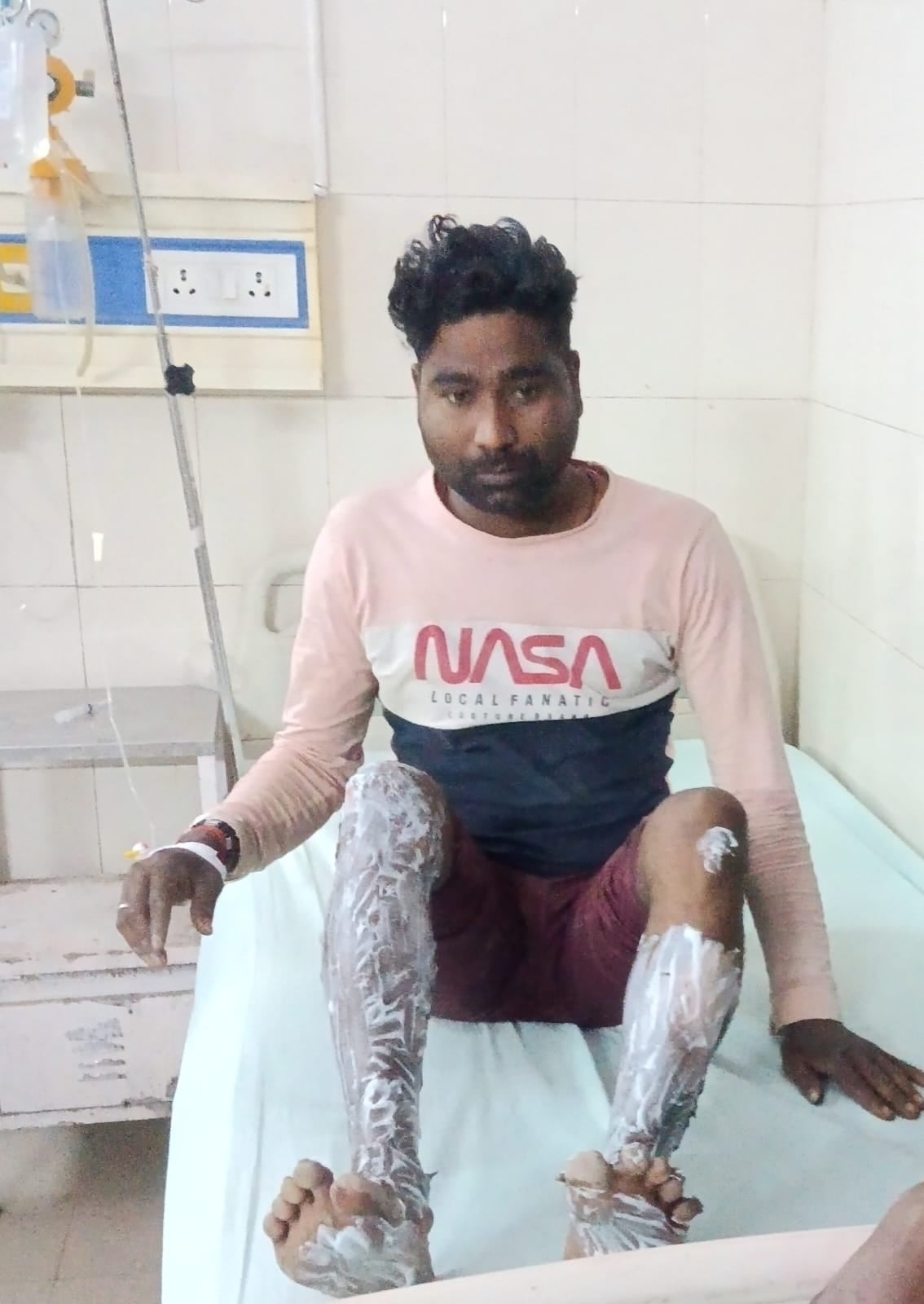 मेडिकल कॉलेज में भर्ती आग से झुलसा बच्चा । संवाद मेडिकल कॉलेज में भर्ती आग से झुलसा बच्चा । संवाद