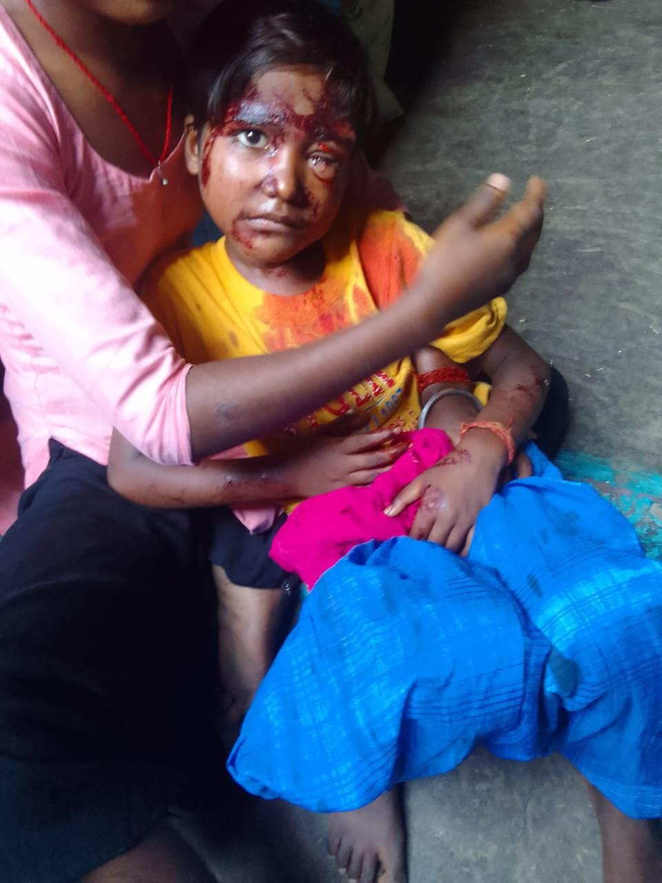 जहानाबाद थाना क्षेत्र के गांव मीरपुर में सियार के हमले में घायल ग्रामीण।स्रोत:ग्रामीण
