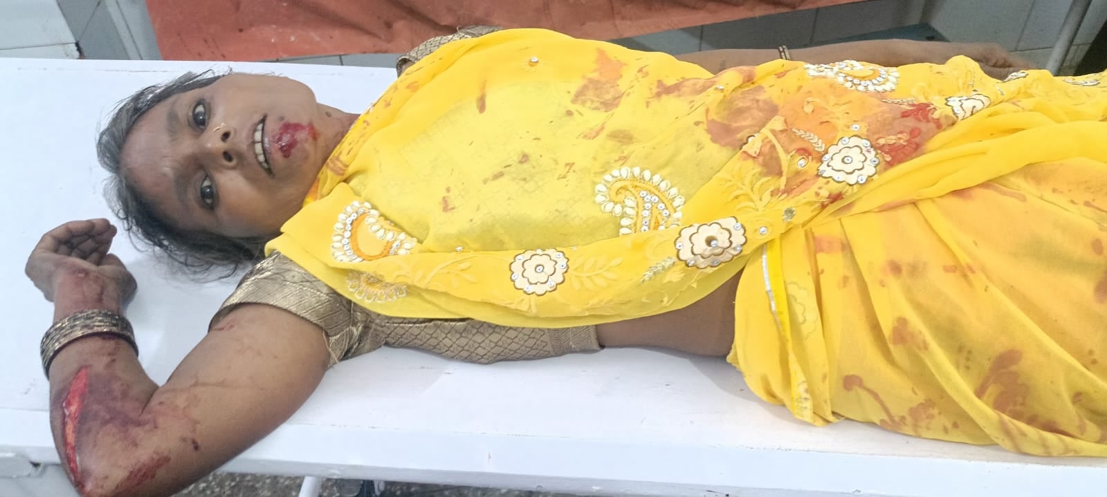 बीसलपुर सामुदायिक स्वास्थय केंद्र में भर्ती घायल नन्ही देवी। संवाद बीसलपुर सामुदायिक स्वास्थय केंद्र में भर्ती घायल नन्ही देवी। संवाद