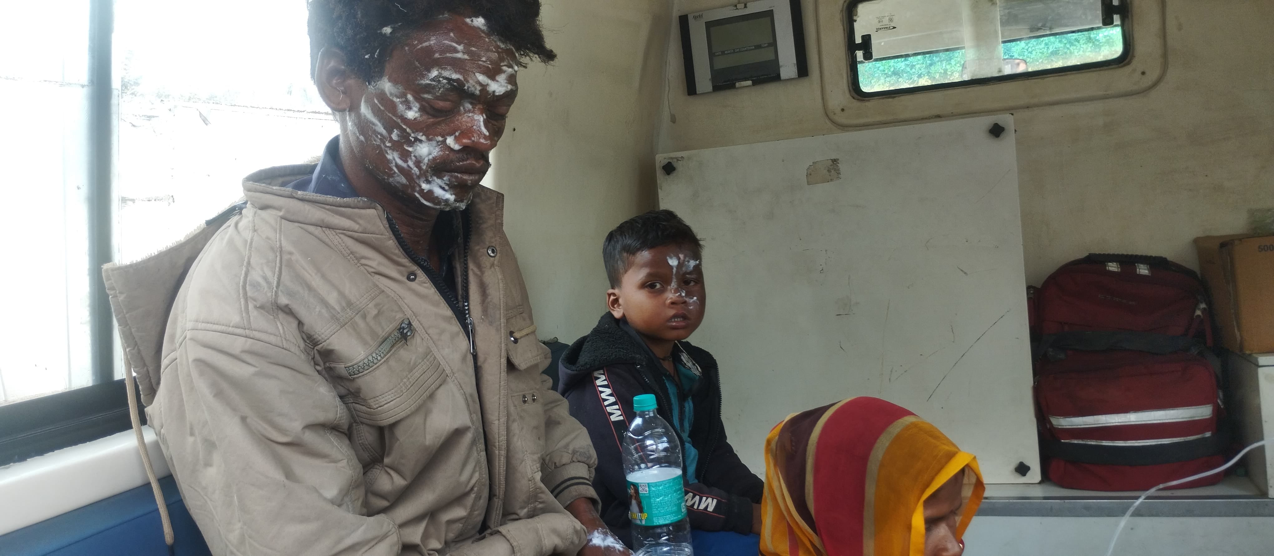 आग के कारण झुलसा पांच वर्षीय महेश। संवाद आग के कारण झुलसा पांच वर्षीय महेश। संवाद
